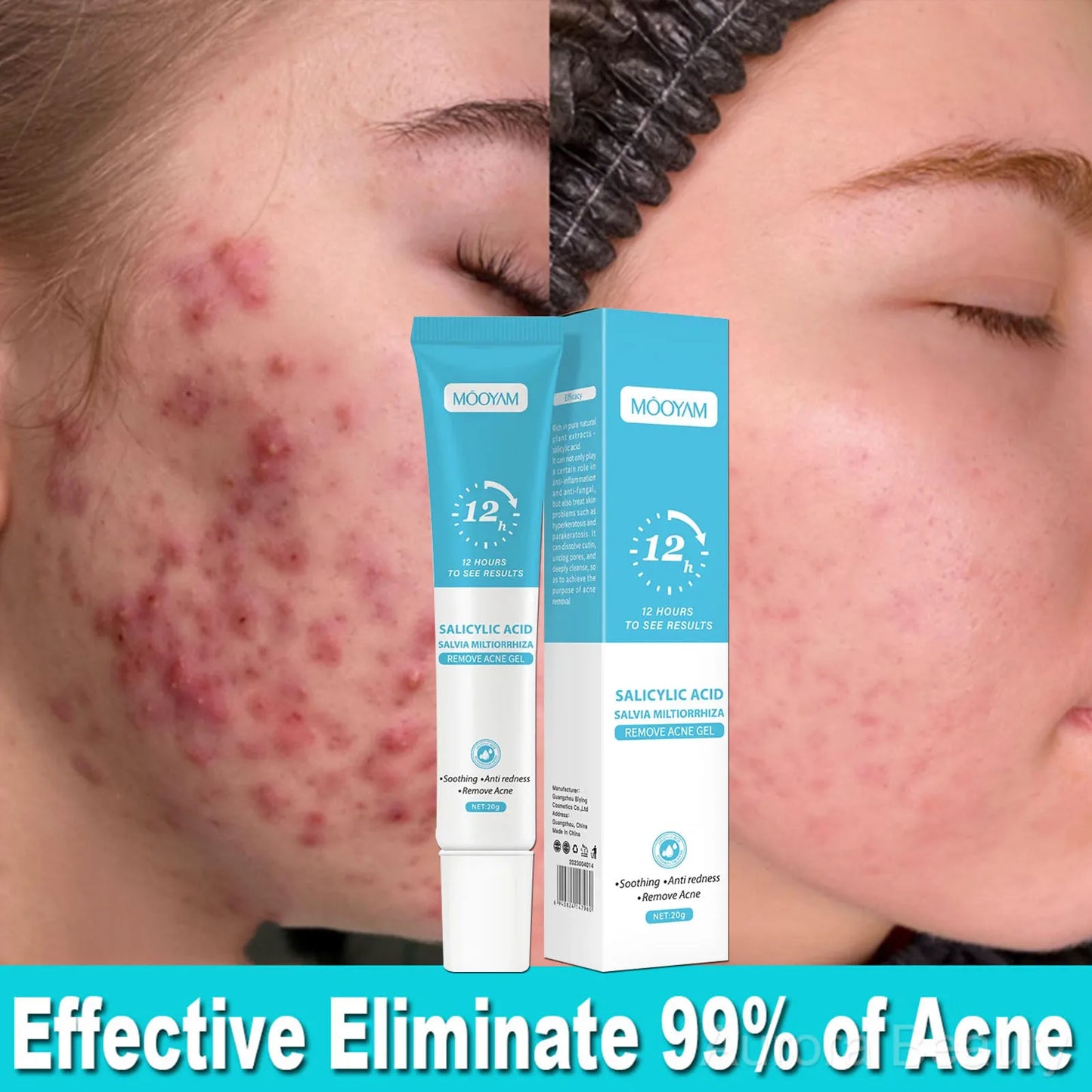 Crème anti-acné visage – Boutons, pores resserrés & peau lissée